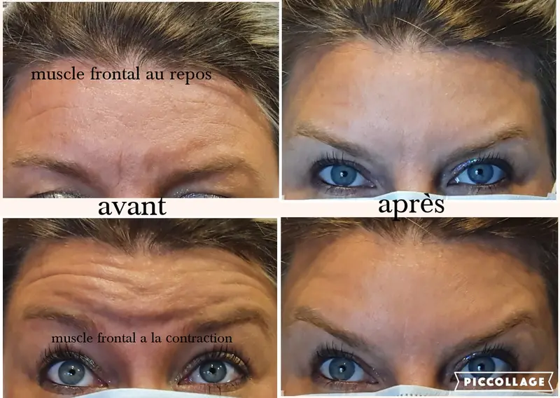 Injection de Botox à Liège