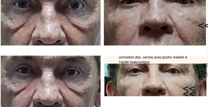 Zones d'injection acide hyaluronique sur le visage